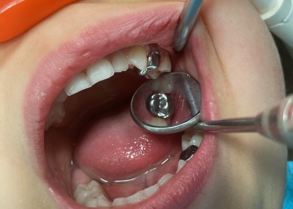 How Long Is a New Crown Sensitive?